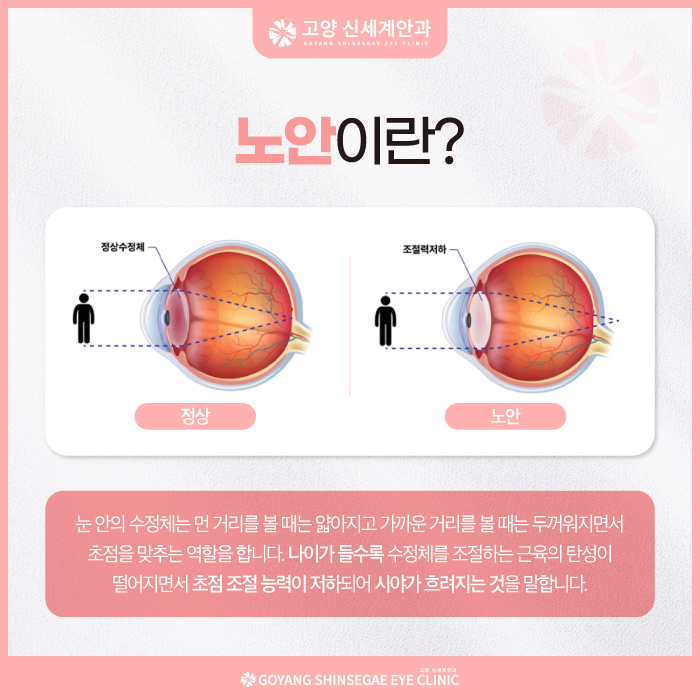 Cataract explained — Goyang Shinsegae Eye Clinic, Ilsan
