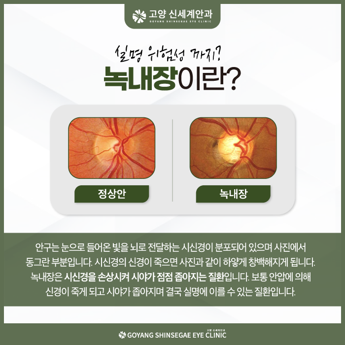 Glaucoma explained — Goyang Shinsegae Eye Clinic, Ilsan